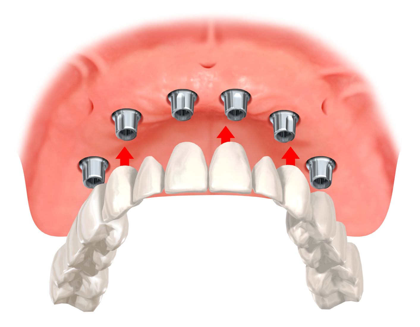 Базальная имплантация на верхней челюсти