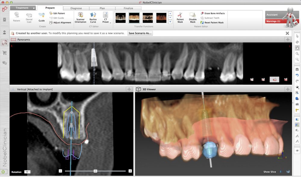 Moderne 3D Implantatplanung