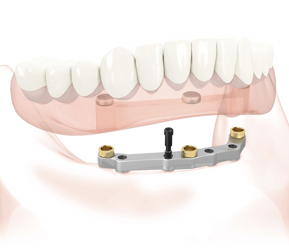 Протезирование зубов инвалидам 3 группы. Балочный протез на 4 имплантах. 4 Импланта и балочный протез. Покрывной протез на балке на 4 имплантах. Внутрислизистые зубные имплантаты.