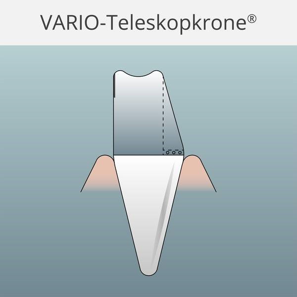 Die VARIO-Teleskopkrone®: Herausnehmbarer Zahnersatz mit optimalem Halt durch spezielle Bearbeitungstechnik
