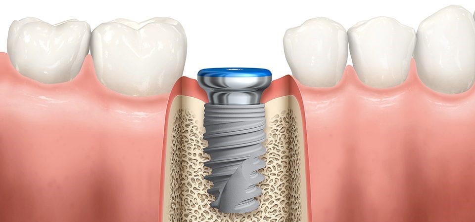 Zahnimplantat Im Unterkiefer