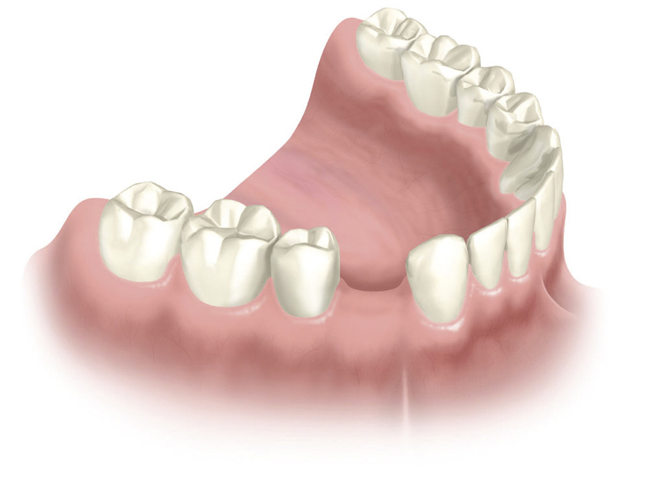 Zahnverlust durch Paradontose