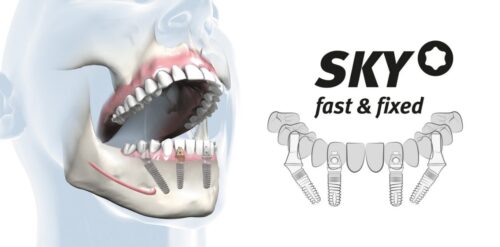 SKY® fast & fixed: Neue Zähne an einem Tag