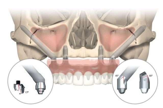 Zygoma-Implantate - Zahnimplantate im Oberkiefer. Zygoma-Implantate nutzen den harten Knochen des Jochbeins für festen Halt.